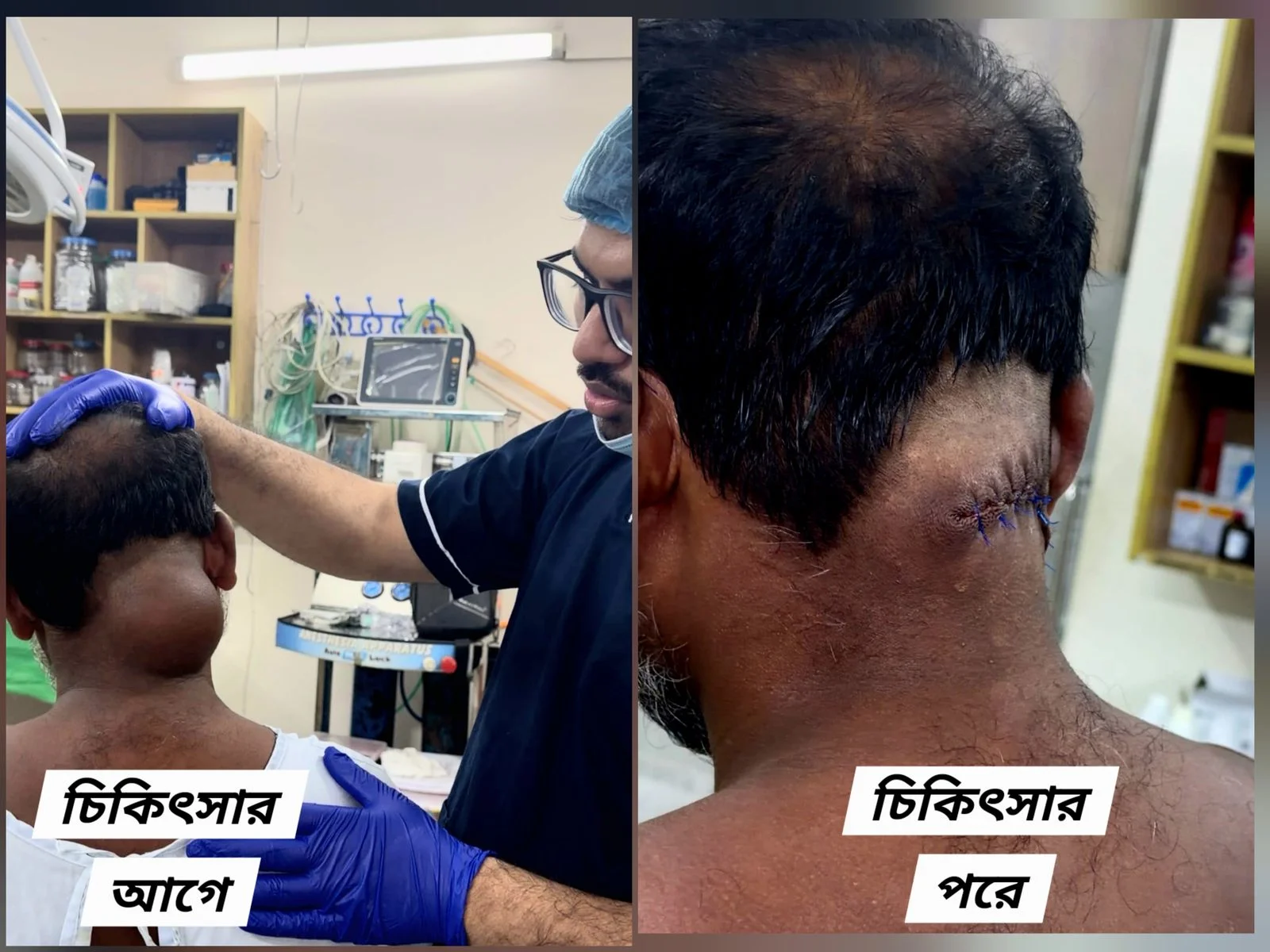 গলার লাইপোমা
