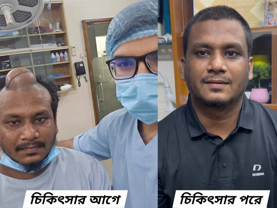 মাথার টিউমার